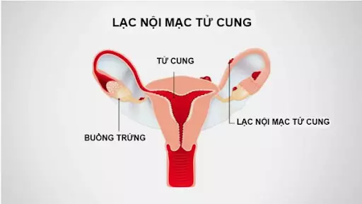 lac-noi-mac-tu-cung-la-nguyen-nhan-pho-bien-gay-u-nang-buong-trung.webp